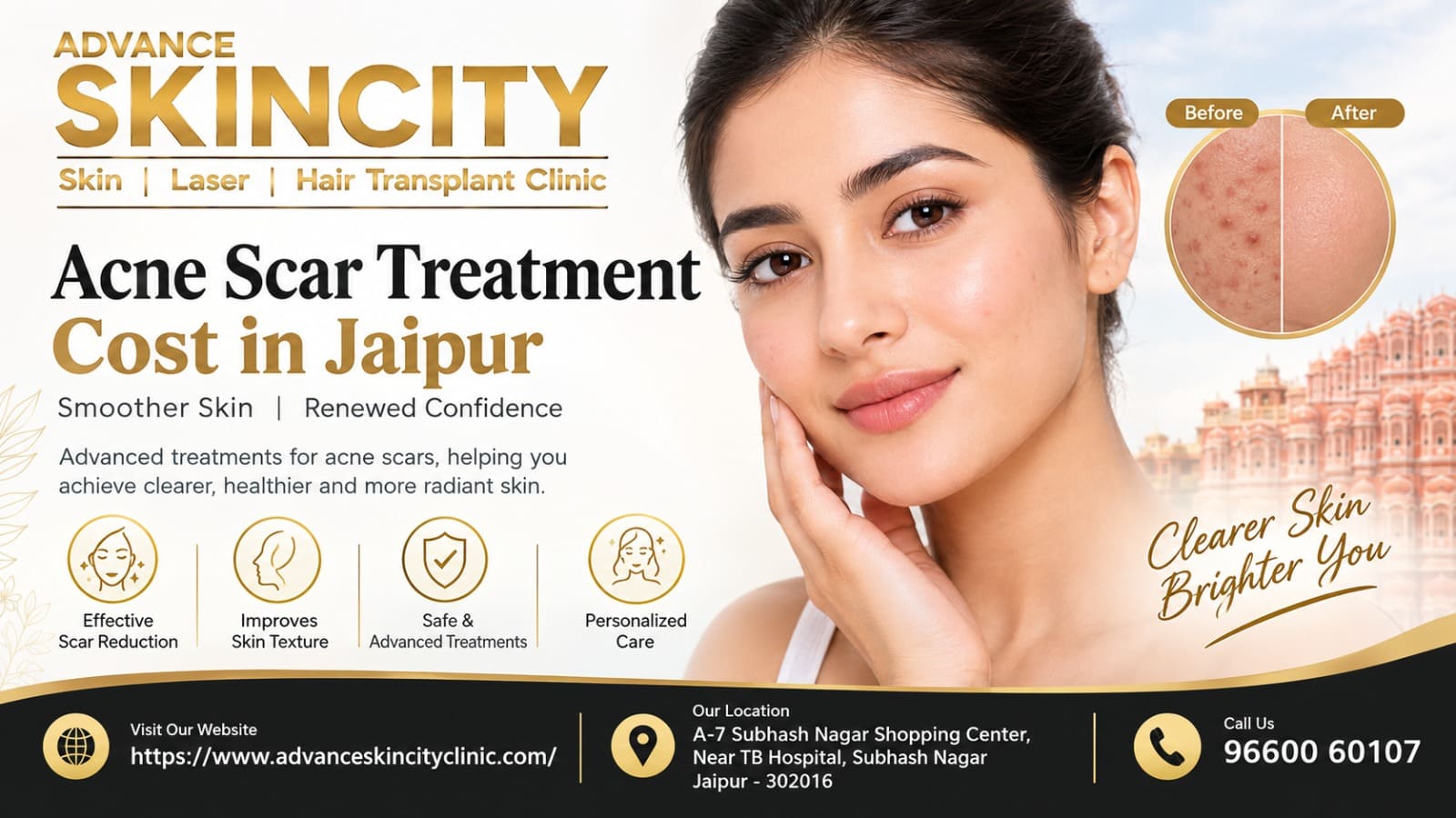 Acne Scar Treatment Cost