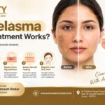 Melasma laser treatment