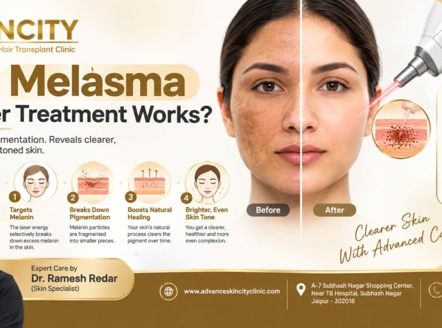 Melasma laser treatment