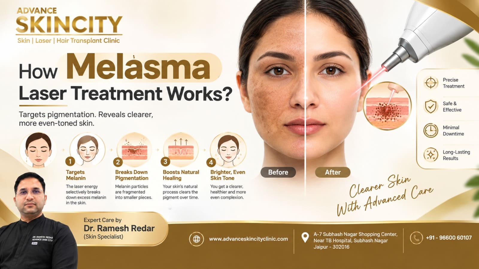 Melasma laser treatment